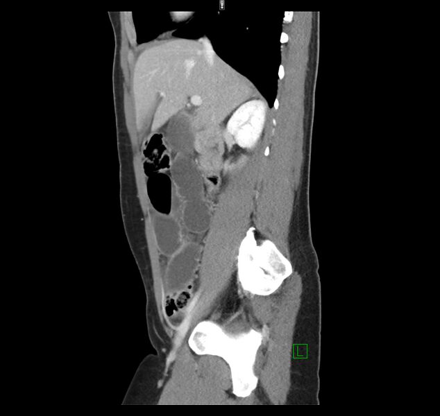 File:Broad ligament hernia (Radiopaedia 63260-71832 C 19).jpg