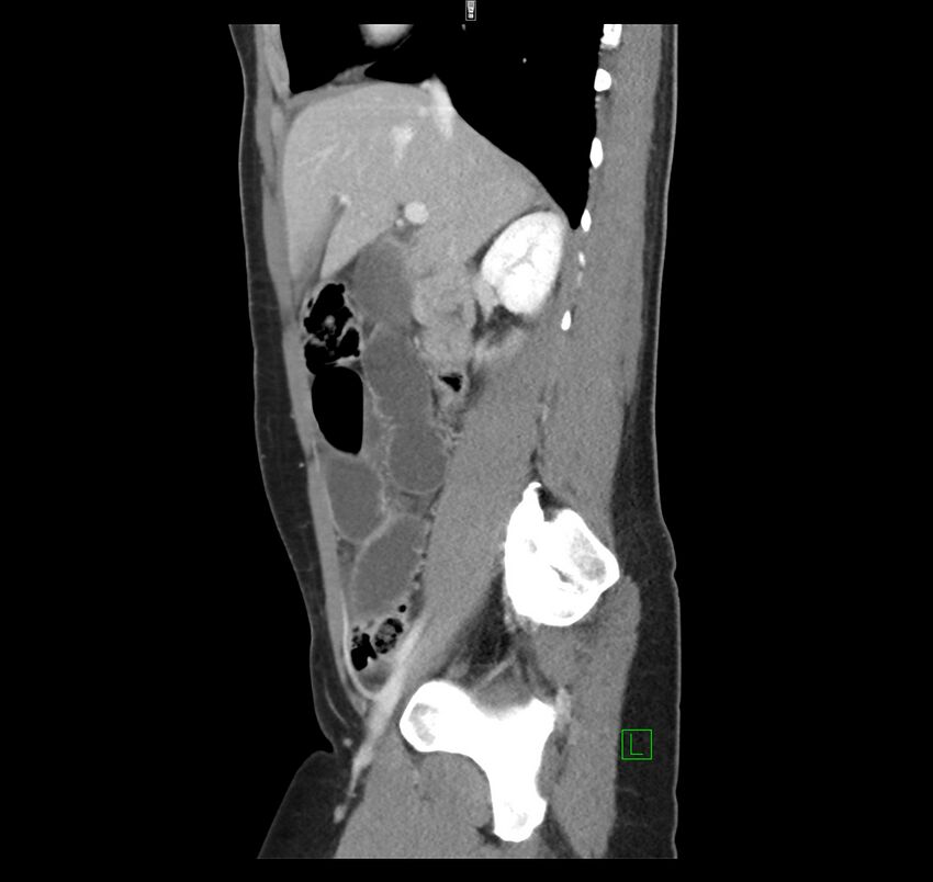 Broad ligament hernia (Radiopaedia 63260-71832 C 19).jpg