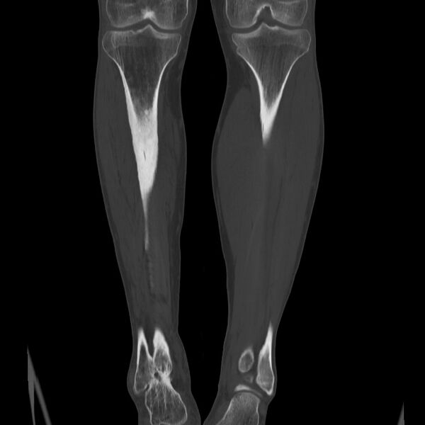 File:Brodie abscess - tibia (Radiopaedia 66028-75204 Coronal bone window 39).jpg