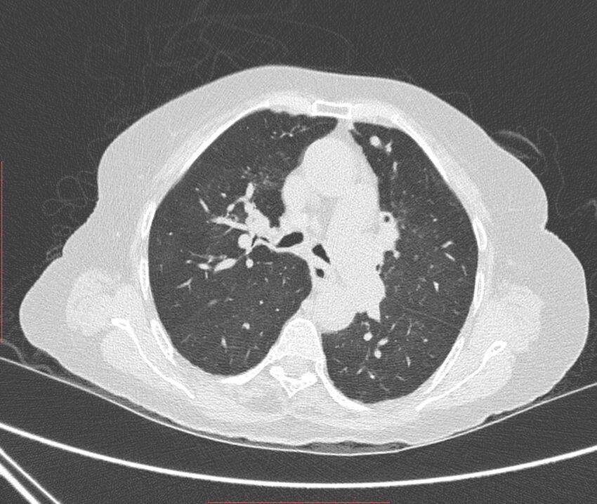 Bronchiectasis (Radiopaedia 72693-83293 Axial lung window 52).jpg