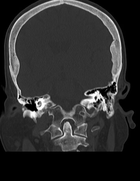 File:Burnt-out meningioma (Radiopaedia 51557-57337 Coronal bone window 29).jpg
