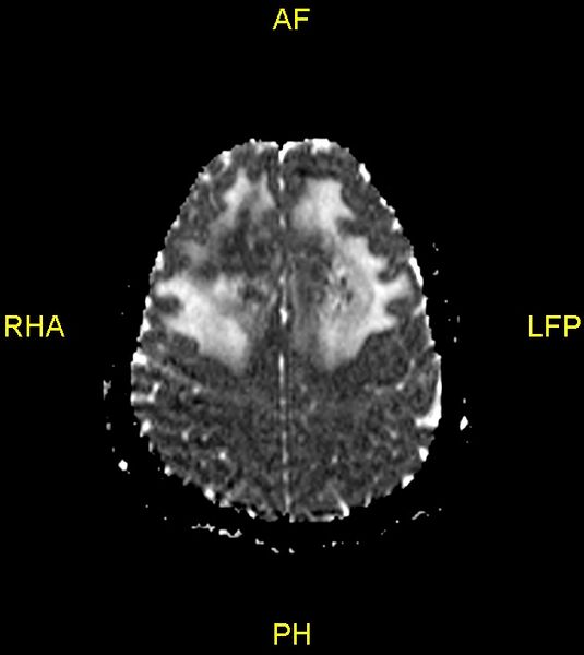File:Butterfly glioma (Radiopaedia 76707-88526 Axial ADC 21).jpg