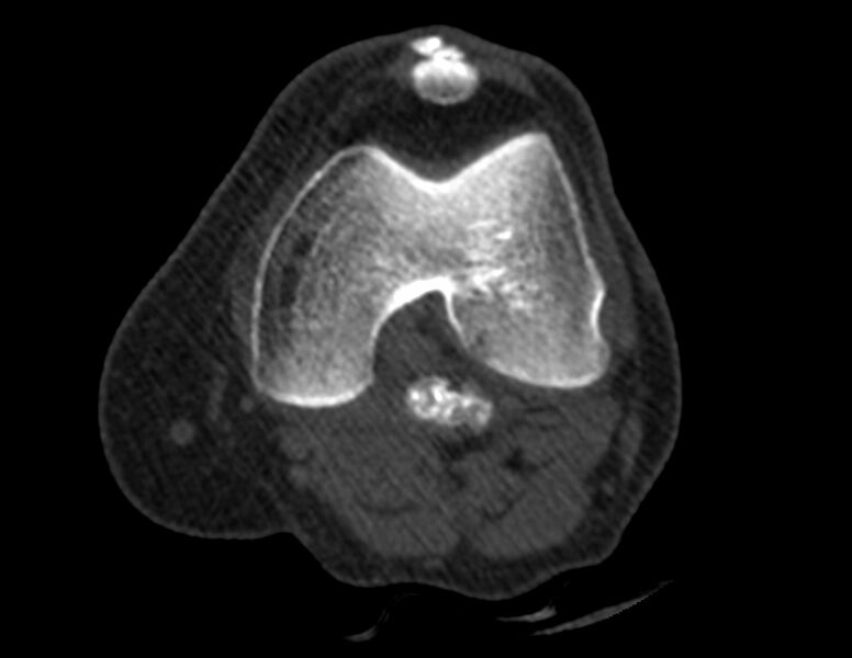 File:Calcified hematoma - popliteal fossa (Radiopaedia 63938-72763 Axial bone window 7).jpg