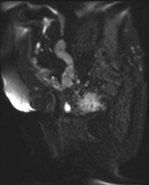 File:Cancer cervix - stage IIb (Radiopaedia 75411-86615 Sagittal DWI 5).jpg