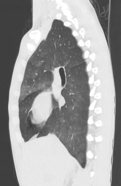 File:Cannabis-induced diffuse alveolar hemorrhage (Radiopaedia 89834-106946 Sagittal lung window 56).jpg