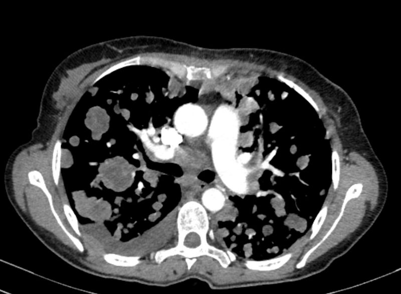 File:Cannonball metastases from breast cancer (Radiopaedia 91024-108569 A 51).jpg