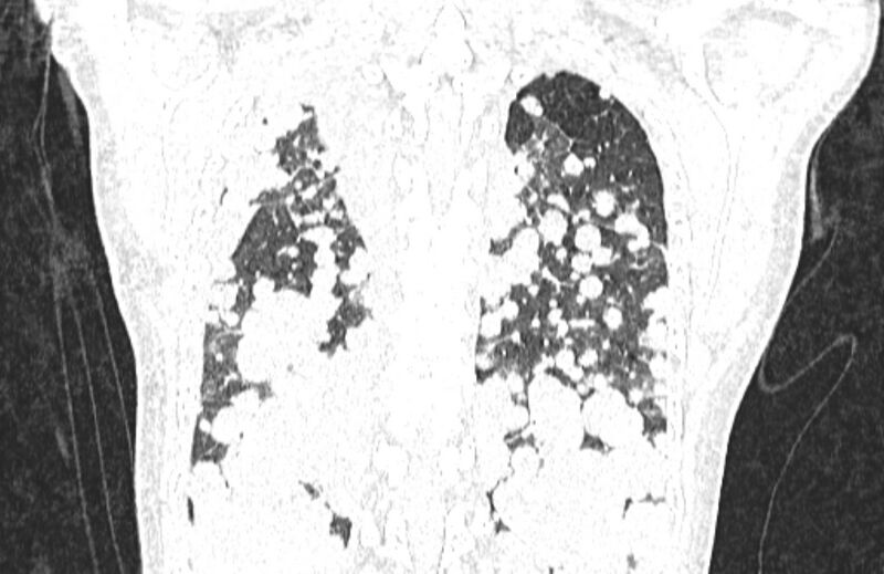 File:Cannonball metastases from breast cancer (Radiopaedia 91024-108569 Coronal lung window 119).jpg
