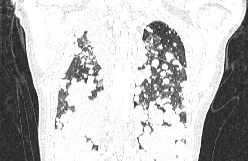 File:Cannonball metastases from breast cancer (Radiopaedia 91024-108569 Coronal lung window 120).jpg