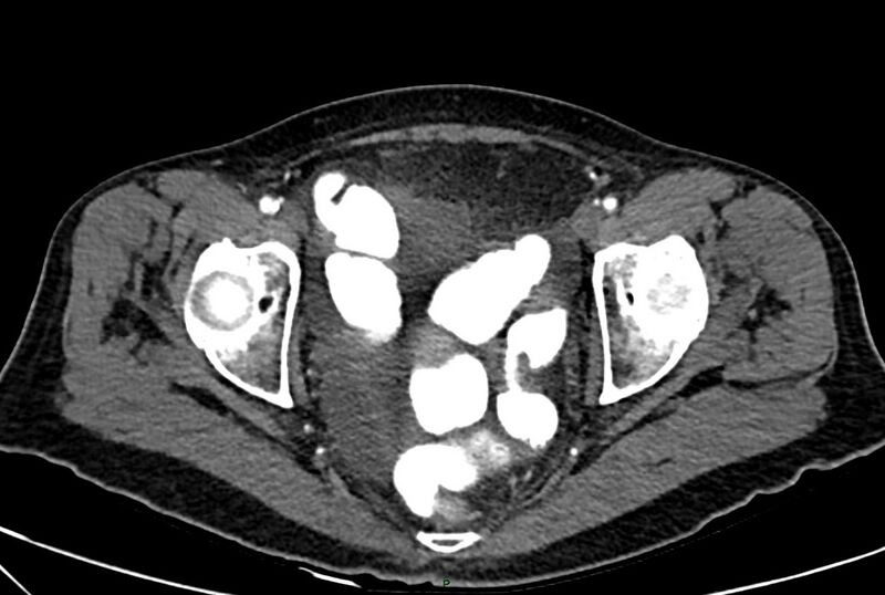 File:Carcinoid mesenteric tumor complicated by chylous ascites (Radiopaedia 76312-88926 A 69).jpg