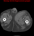 Cardiac perforation following transcatheter aortic valve implantation (Radiopaedia 23714-23863 B 29).png