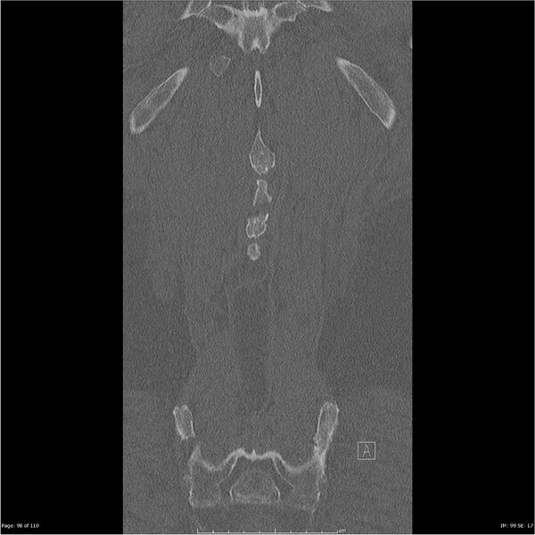 File:Cardiac trauma (Radiopaedia 32874-33858 Coronal bone window 98).jpg