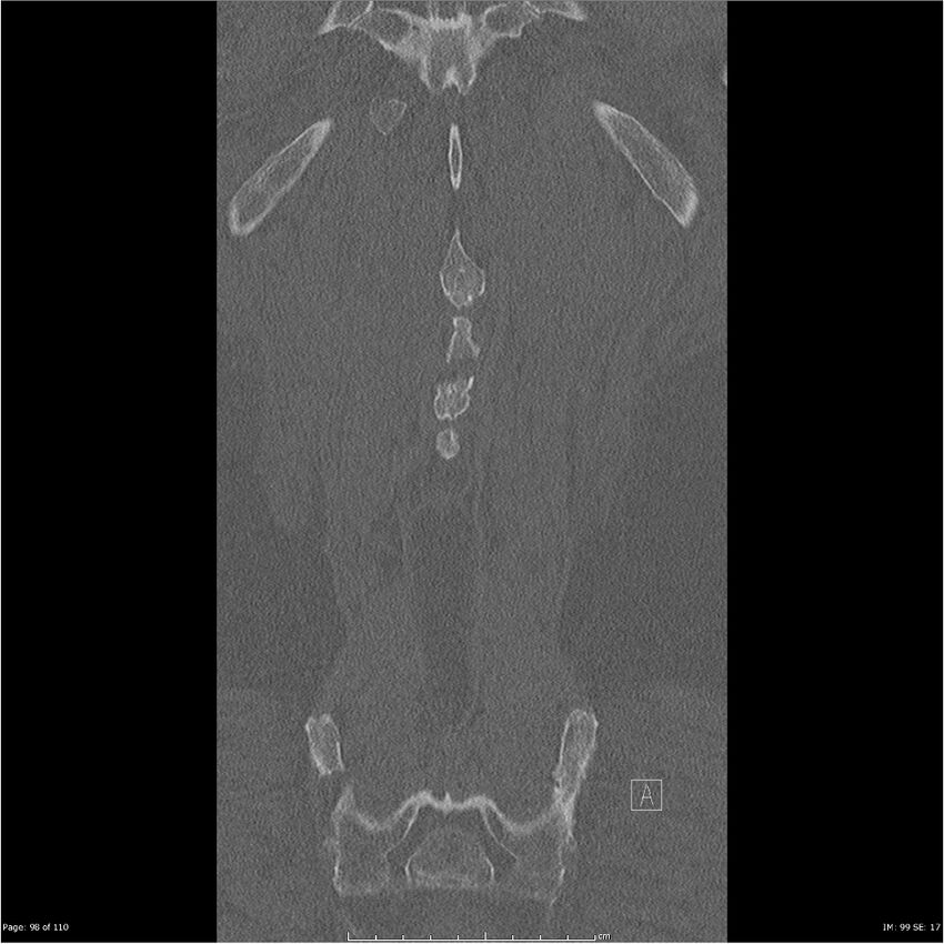 Cardiac trauma (Radiopaedia 32874-33858 Coronal bone window 98).jpg
