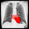 Cardiomediastinal anatomy on chest radiography (annotated images) (Radiopaedia 46331-50742 K 1).png