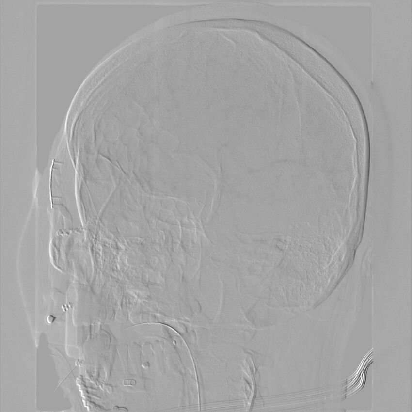Caroticocavernous fistula - direct (Radiopaedia 61660-69666 Oblique Left ICA 48).jpg