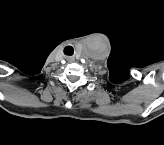 File:Carotid artery pseudoaneurysm (Radiopaedia 84030-99259 C 61).jpg