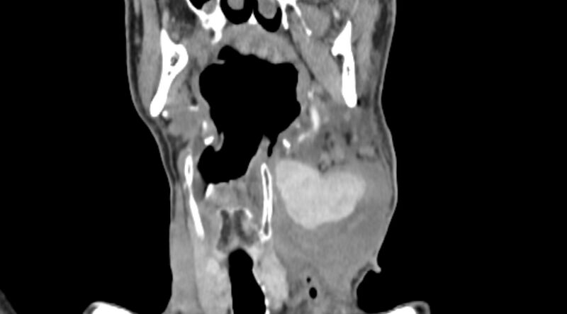 File:Carotid artery pseudoaneurysm (Radiopaedia 84030-99259 D 37).jpg