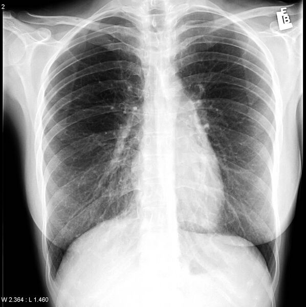 File:Catamenial pneumothorax (Radiopaedia 24847-25113 B 1).jpg