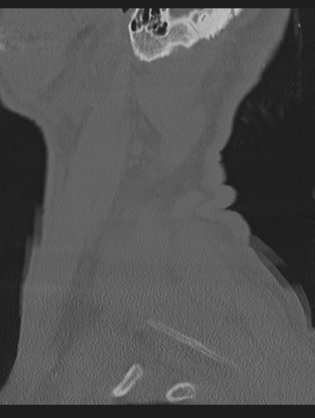 File:Cavernoma of cervical cord (Radiopaedia 50838-56346 Sagittal bone window 76).png
