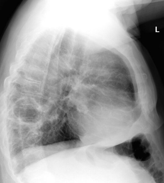 File:Cavitating left lower lobe lesion - squamous cell lung cancer (Radiopaedia 27749-27978 Lateral 1).JPG