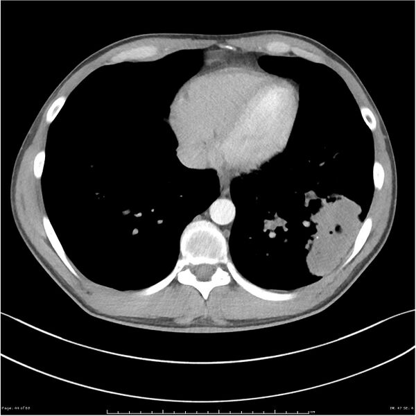 File:Cavitating lung cancer (Radiopaedia 25796-25945 C+ arterial phase 44).jpg