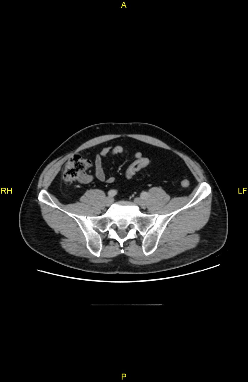 Cecal epiploic appendagitis (Radiopaedia 86047-102164 A 109).jpg