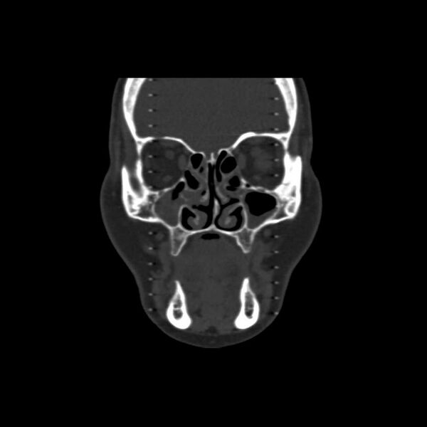 File:Cemento-ossifying fibroma (Radiopaedia 21243-21149 Coronal bone window 8).jpg