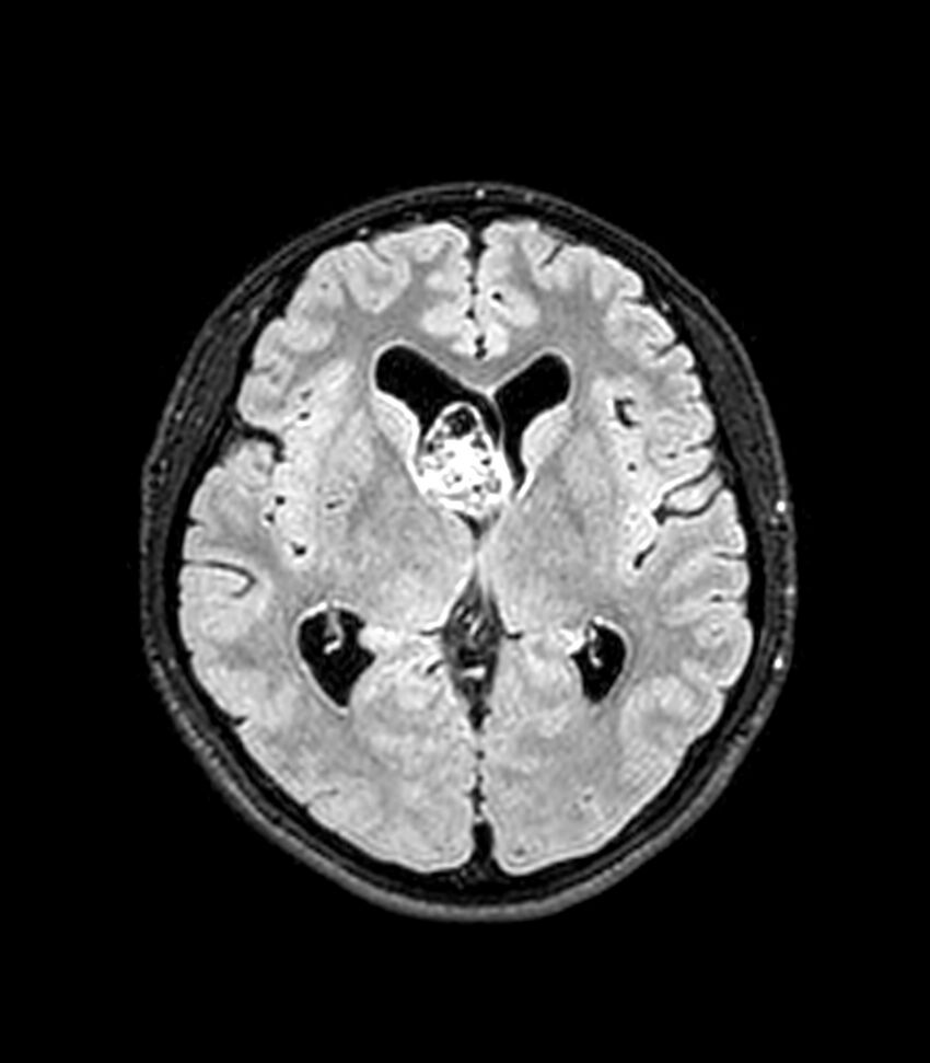 Central neurocytoma (Radiopaedia 79320-92380 Axial FLAIR 162).jpg