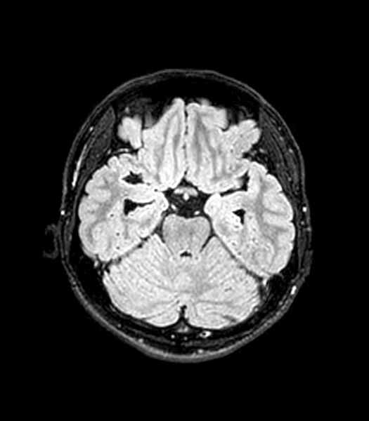 File:Central neurocytoma (Radiopaedia 79320-92380 Axial FLAIR 203).jpg