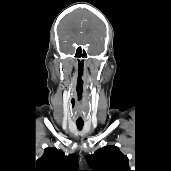 File:Cerebellar infarct due to vertebral artery dissection with posterior fossa decompression (Radiopaedia 82779-97029 D 24).png