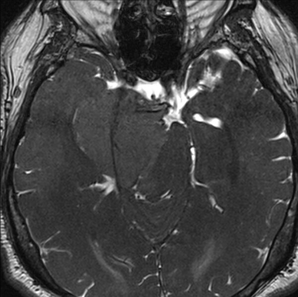 File:Cerebellopontine angle meningioma (Radiopaedia 24459-24764 I 35).jpg