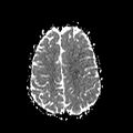 Cerebral abscess post cardiac surgery (Radiopaedia 27244-27420 Axial ADC 19).jpg
