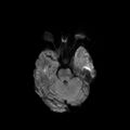 Cerebral abscess post cardiac surgery (Radiopaedia 27244-27420 Axial DWI 4).jpg
