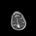 Cerebral abscess post cardiac surgery (Radiopaedia 27244-27420 Axial T1 C+ 21).jpg