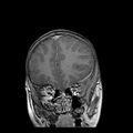 Cerebral abscess post cardiac surgery (Radiopaedia 27244-27420 Coronal T1 C+ 4).jpg