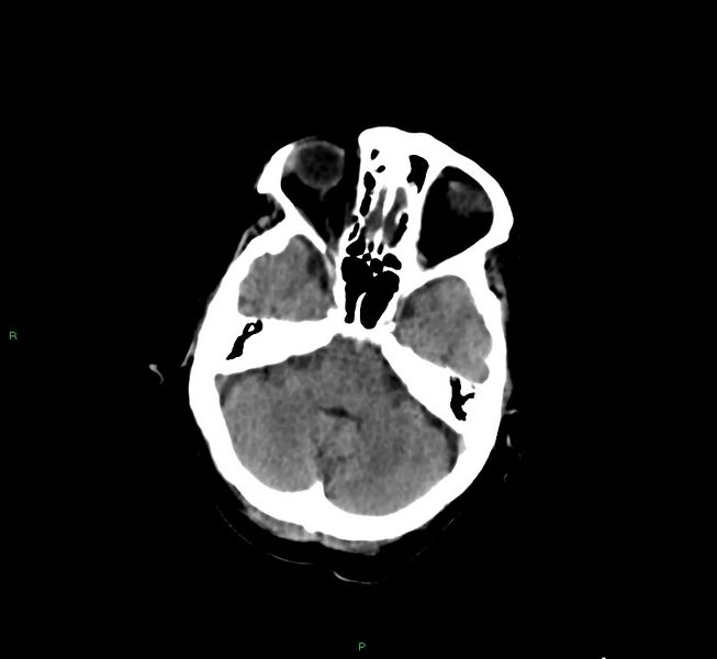 File:Cerebral amyloid angiopathy-associated lobar intracerebral hemorrhage (Radiopaedia 58377-65514 Axial non-contrast 37).jpg