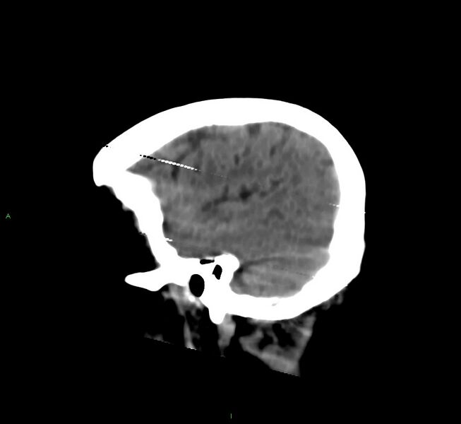 File:Cerebral amyloid angiopathy-associated lobar intracerebral hemorrhage (Radiopaedia 58377-65514 B 9).jpg