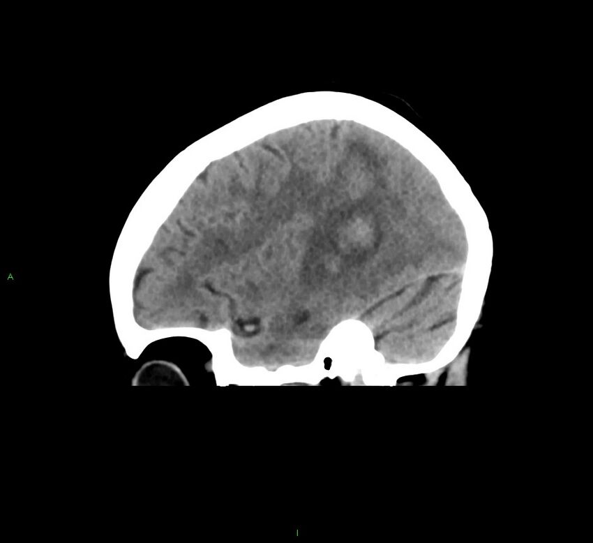 Cerebral amyloid angiopathy-associated lobar intracerebral hemorrhage (Radiopaedia 58378-65516 C 15).jpg