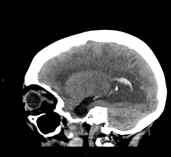 File:Cerebral amyloid angiopathy-associated lobar intracerebral hemorrhage (Radiopaedia 58379-65519 C 37).jpg