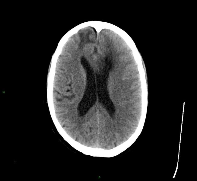 File:Cerebral amyloid angiopathy-associated lobar intracerebral hemorrhage (Radiopaedia 58529-65681 Axial non-contrast 22).jpg
