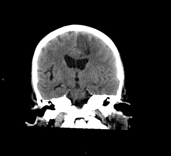 File:Cerebral amyloid angiopathy-associated lobar intracerebral hemorrhage (Radiopaedia 58529-65681 Coronal non-contrast 34).jpg