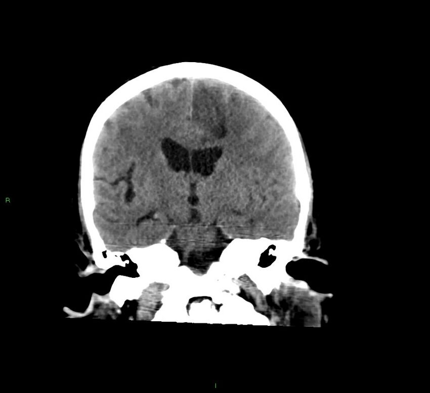 Cerebral amyloid angiopathy-associated lobar intracerebral hemorrhage (Radiopaedia 58529-65681 Coronal non-contrast 34).jpg