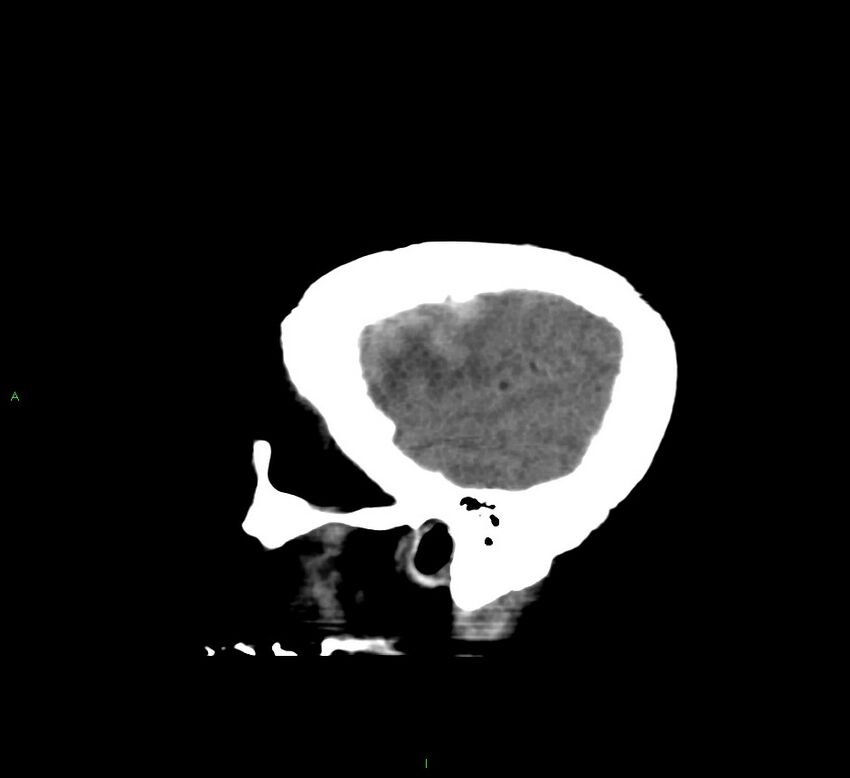 Cerebral amyloid angiopathy-associated lobar intracerebral hemorrhage (Radiopaedia 58560-65723 C 7).jpg