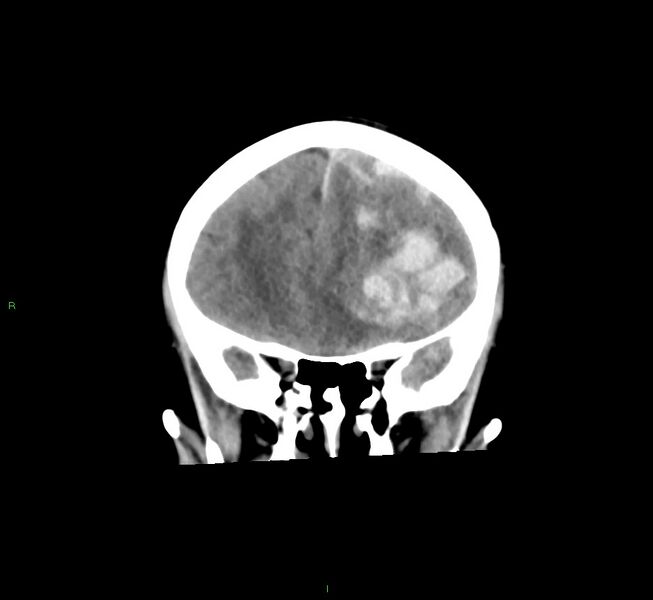 File:Cerebral amyloid angiopathy-associated lobar intracerebral hemorrhage (Radiopaedia 58561-65724 Coronal non-contrast 44).jpg