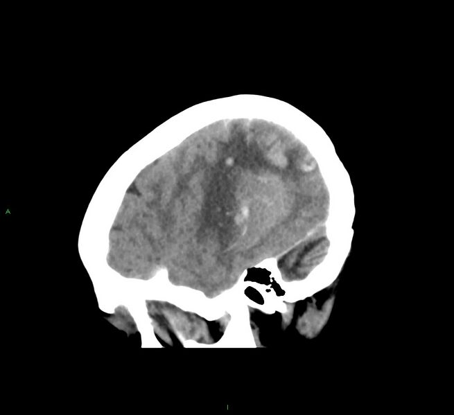 File:Cerebral amyloid angiopathy-associated lobar intracerebral hemorrhage (Radiopaedia 58563-65727 C 13).jpg