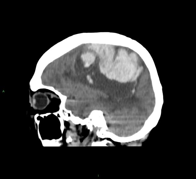 File:Cerebral amyloid angiopathy-associated lobar intracerebral hemorrhage (Radiopaedia 58751-65972 C 19).jpg