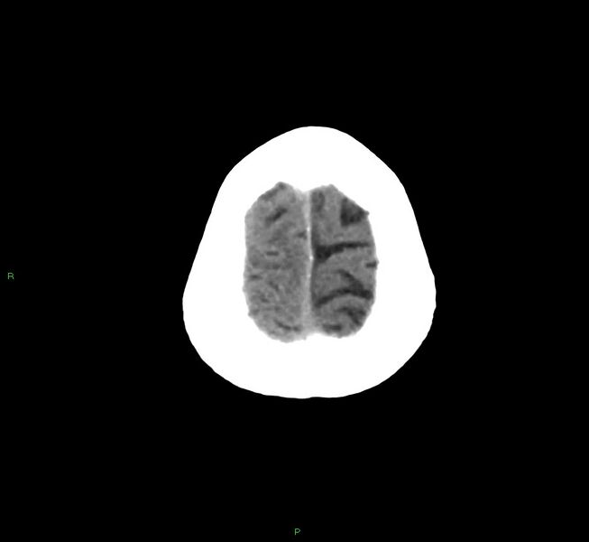 File:Cerebral amyloid angiopathy-associated lobar intracerebral hemorrhage (Radiopaedia 58758-65980 Axial non-contrast 6).jpg