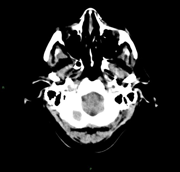 File:Cerebral amyloid angiopathy-associated lobar intracerebral hemorrhage (Radiopaedia 59356-66716 Axial non-contrast 43).jpg