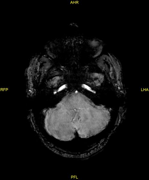 File:Cerebral autosomal dominant arteriopathy with subcortical infarcts and leukoencephalopathy (CADASIL) (Radiopaedia 86108-102054 Axial SWI 26).jpg