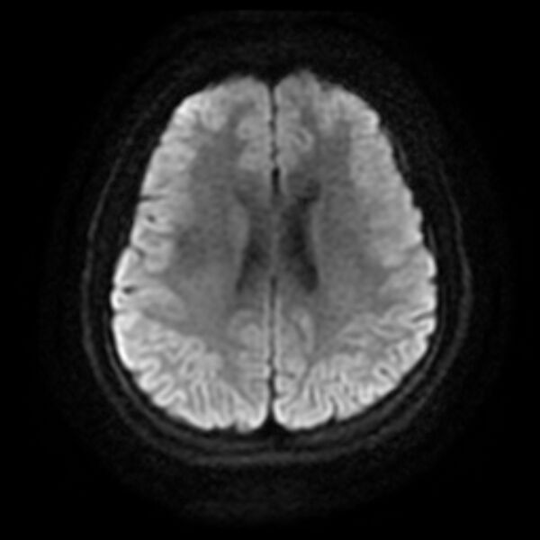 File:Cerebral cavernous malformation (Radiopaedia 44301-47942 Axial DWI 14).jpg