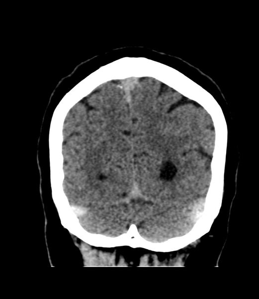File:Cerebral dural venous sinus thrombosis (Radiopaedia 86514-102575 Coronal non-contrast 44).jpg